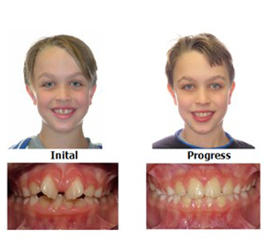 Phase I - Twisted Teeth
