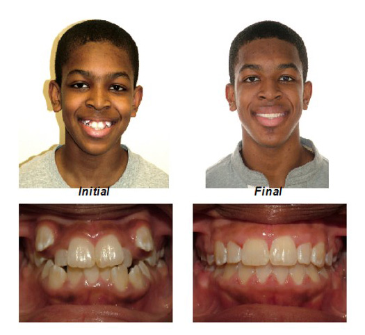 Crowded Teeth - severe upper & lower crowding treated with extraction of 4 teeth