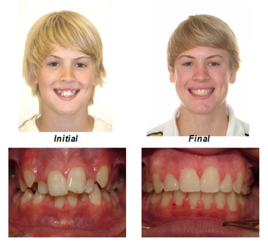 Crowded Teeth-treated with non-extraction of teeth